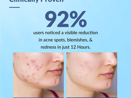 Fixderma Salyzap Acne Spot Corrector Gel - 20 gms